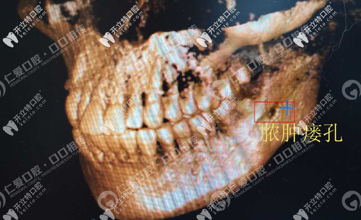 智齒反復(fù)發(fā)炎導(dǎo)致臉頰膿腫