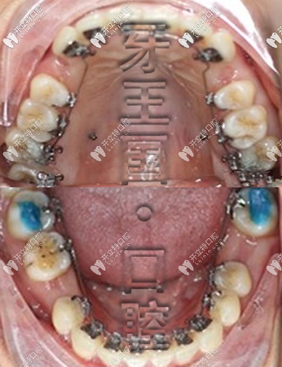 牙王國(guó)口腔舌側(cè)矯正案例