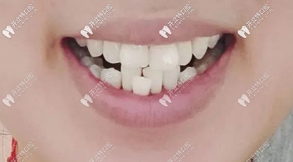 小姐姐戴牙套整牙前的牙齒圖