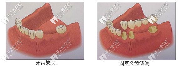 固定義齒修復