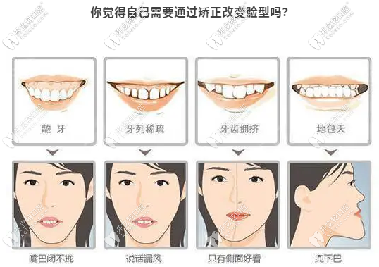 看看自己需要通過整牙來(lái)改變臉型嗎