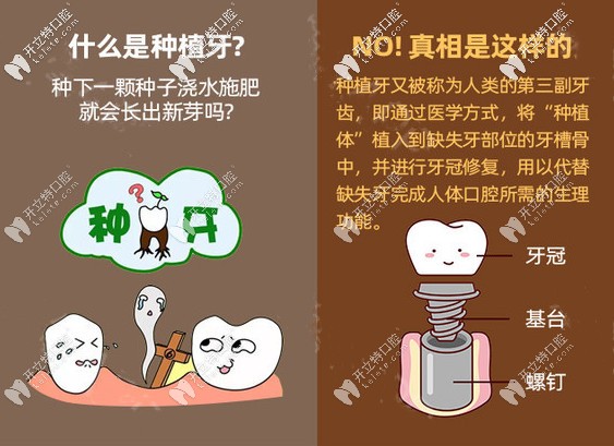 在廣州好大夫口腔做進(jìn)口種植牙多少錢(qián),缺牙久了還能種牙嗎