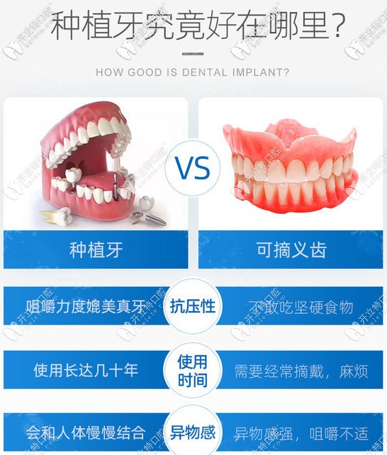 種植牙VS活動假牙