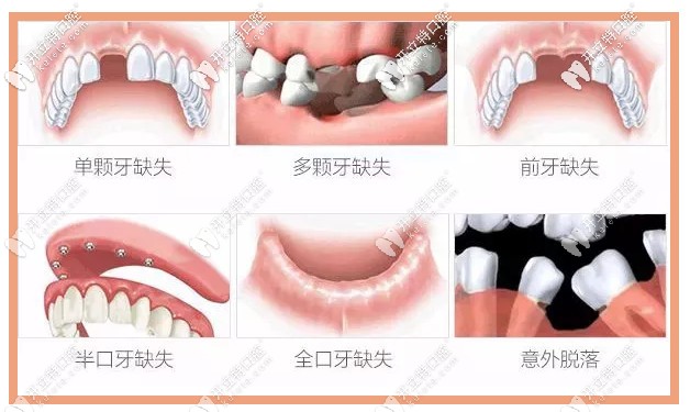 種植牙適應(yīng)癥