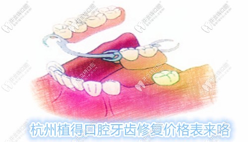 杭州植得口腔鑲牙費(fèi)用表來咯,各種活動(dòng)義齒的修復(fù)價(jià)格都有