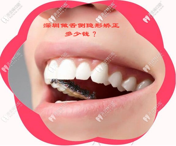 在深圳做舌側(cè)隱形矯正的收費(fèi)價(jià)格是多少錢