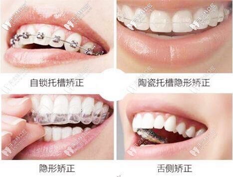 矯正器的幾種
