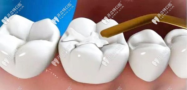 補牙過程的充填修復(fù)