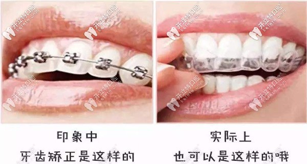 告別鋼牙妹，別錯(cuò)過隱形矯正哦