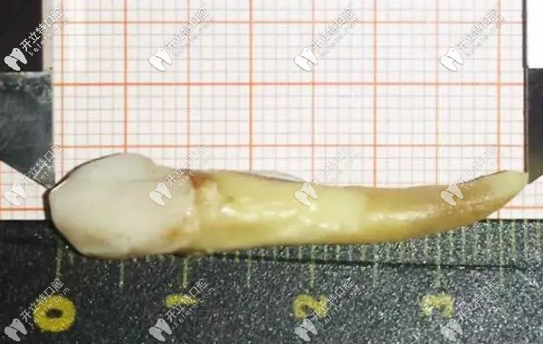 人的智齒較長有幾厘米，3.72厘米的牙齒你見過嗎？