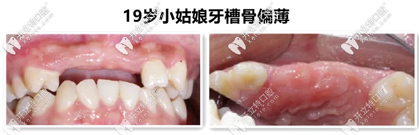 牙槽骨不足，需要植入骨粉