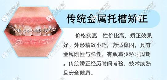 國(guó)產(chǎn)傳統(tǒng)金屬鋼牙套優(yōu)勢(shì)