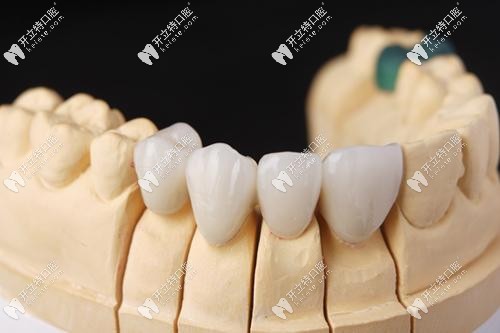 回復(fù)我：美國3m全瓷牙和澤康的區(qū)別？lava全瓷牙多少錢一顆