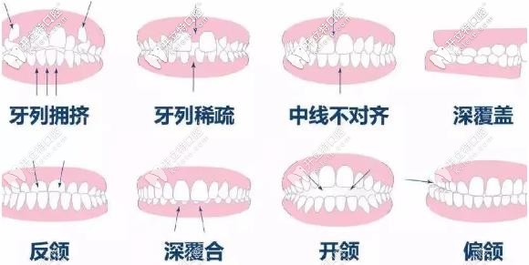 合肥美奧口腔牙齒矯正適應癥