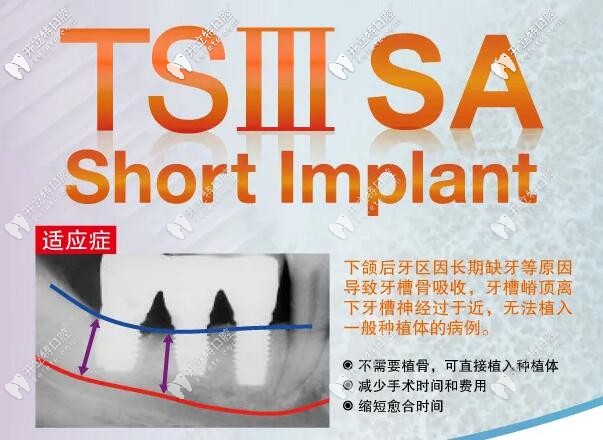 分享:韓國(guó)奧齒泰TSIII SA超短種植體優(yōu)勢(shì)及種植下頜牙的案例