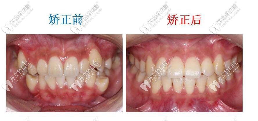矯正案例前后