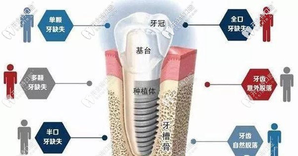 種植牙適應(yīng)癥狀如圖所示