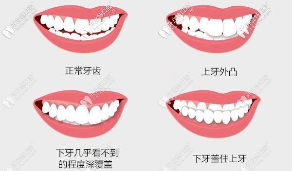 牙齒外凸、深覆合等情況都需要矯正