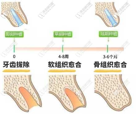 牙齒種植三種術(shù)式的對比