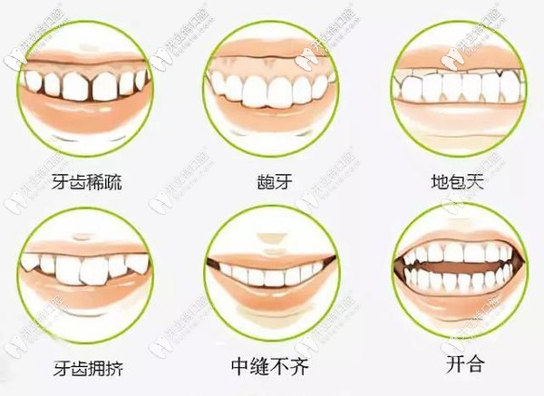 什么樣的牙齒需要矯正