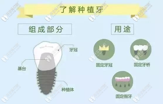 種植牙的組成部分