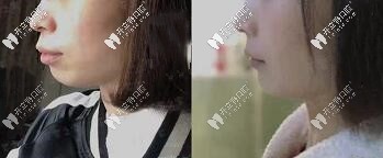 深覆合、齙牙顧客—拔牙7顆做的美國(guó)進(jìn)口自鎖金屬托槽