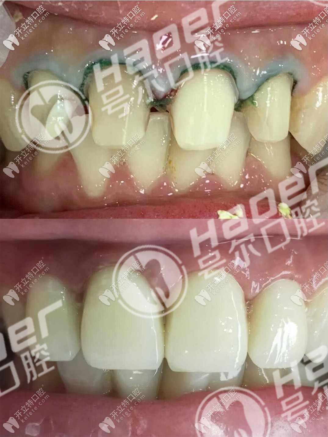 說不痛苦是假的,談?wù)勎铱敬裳烙?年后拆了換全瓷牙過程！