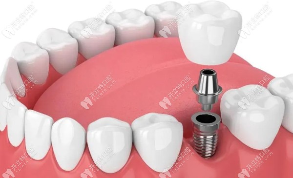 種植牙新品：德國瑞鈦超級骨整合種植系統(tǒng)的優(yōu)勢特點