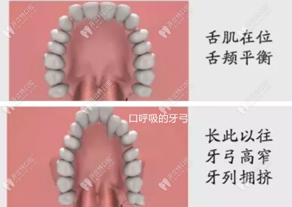正常牙弓和長(zhǎng)期口呼吸牙弓對(duì)比