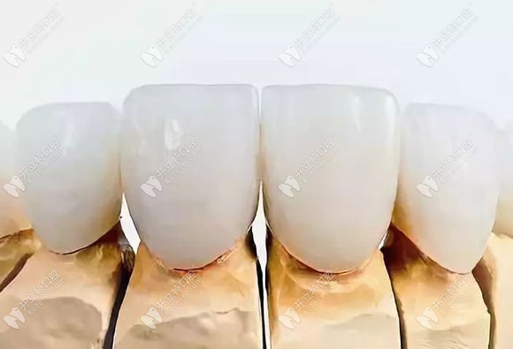 前門牙做氧化鋯全瓷牙的效果圖