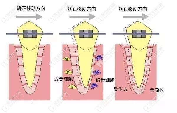 牙齒矯正時(shí)的移動方向