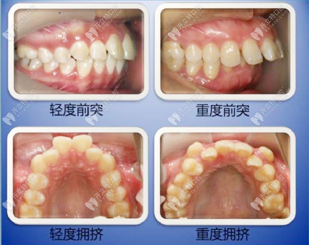 什么情況下需要拔牙才能矯正牙齒？