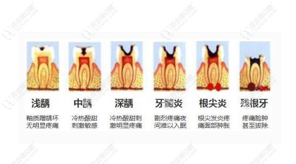 對(duì)于口腔材料:MTA與iroot的區(qū)別到底是什么,終于有答案了