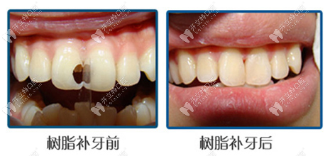 樹脂補牙前后對比